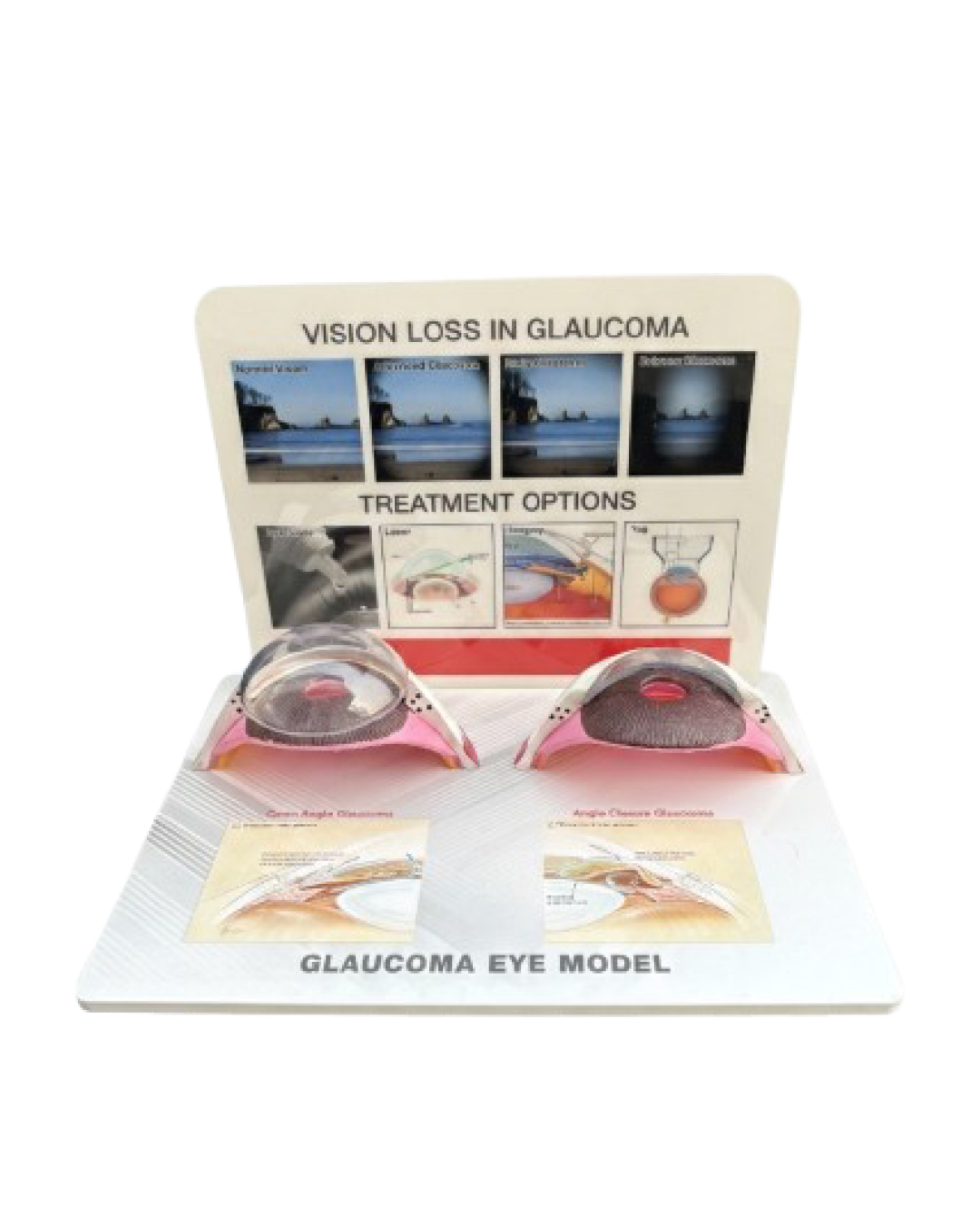 Glaucoma_Eye_Model_1