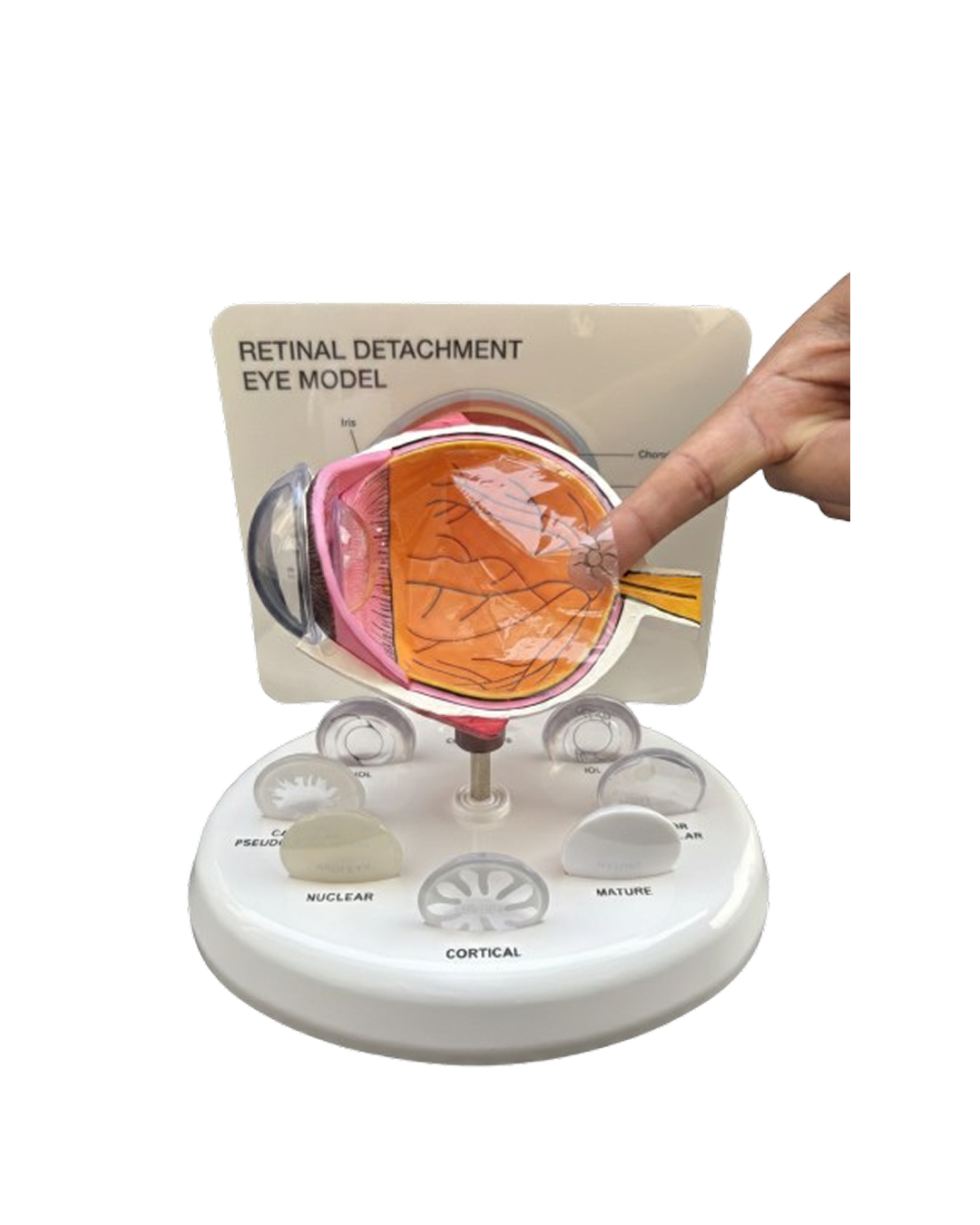 Retinal_Detachment_Eye_Model