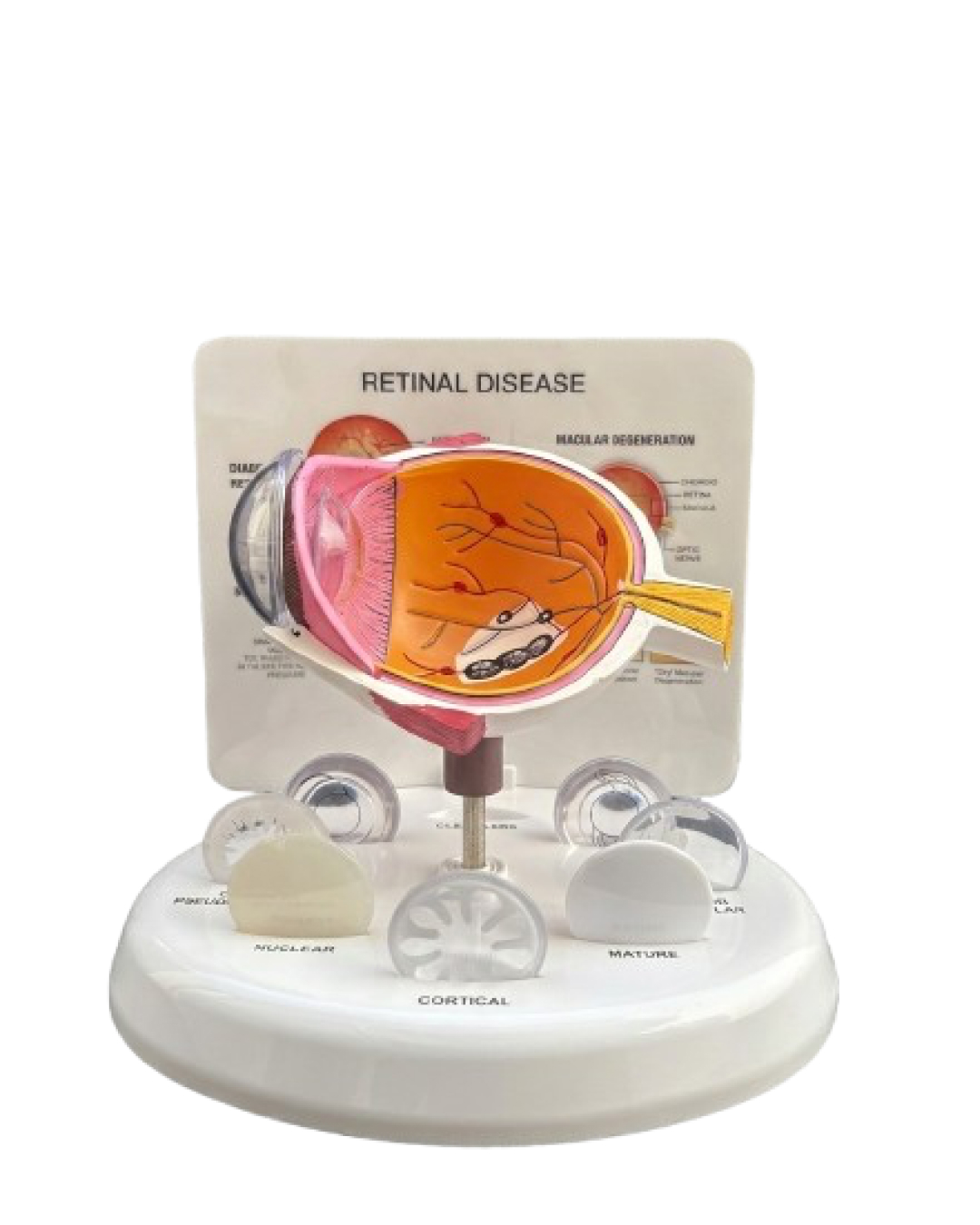 Retinal_Disease_Eye_Model_1